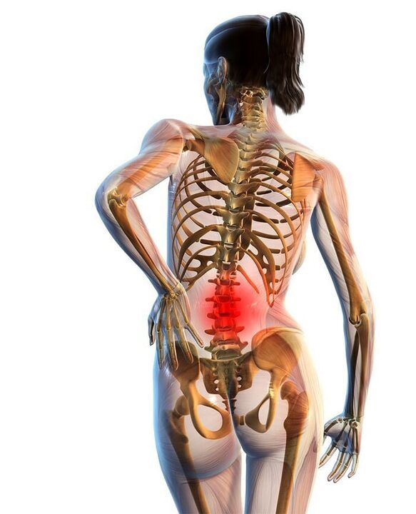Najčešće se javlja osteohondroza lumbalne kralježnice