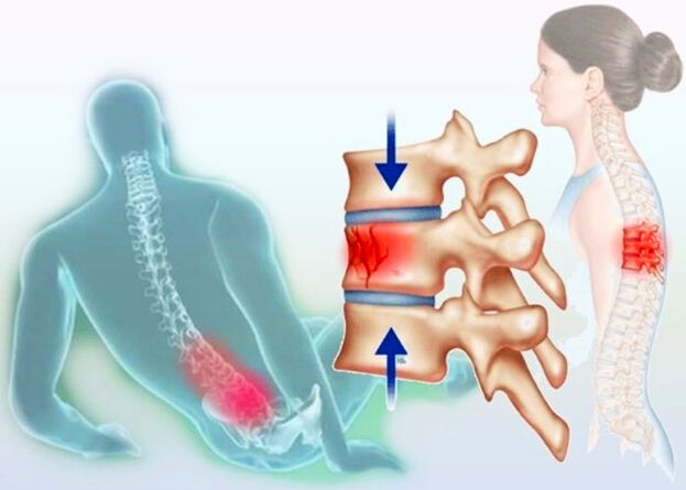 Čak i obična ozljeda može potaknuti razvoj osteohondroze